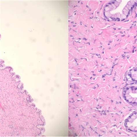 Left 10x Low Power Microscopic View Of Cyst Highlighting Mucinous