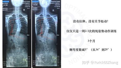 脊柱侧弯案例分析：3个月减少5°（附x光片、训练建议） 知乎