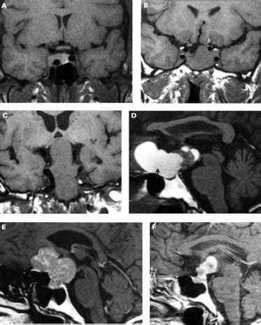 A Intrasellar Macroadenoma Extension Into Right Cavernous Sinus B