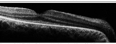 Figure From Ocular And Extra Ocular Features Of Patients With Leber