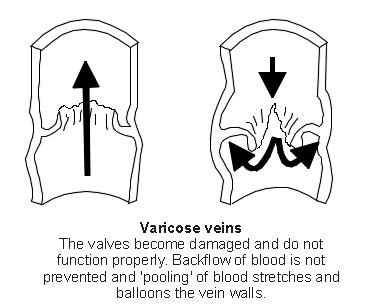 1894: Varicose Ulcer