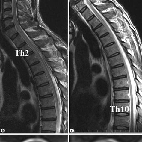 Sagittal Thoracic Spine Magnetic Resonance Imaging Mri Of Patient