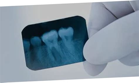 Periapical Radiolucencies - San Diego Dental Health Center