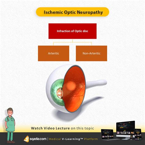 Ischemic Optic Neuropathy | Neuropathy, Optical, Optical coherence ...