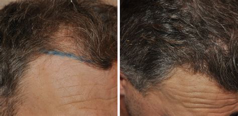 Graft Hair Transplant Coverage Results Costs