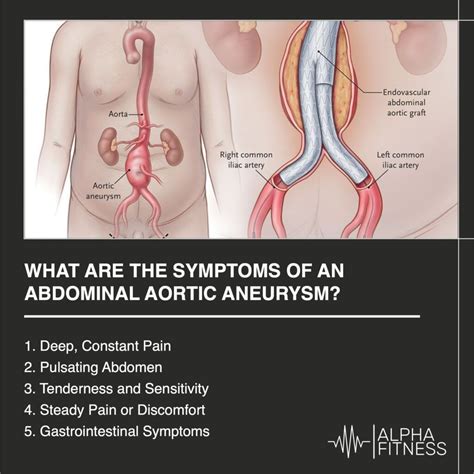 Aortic aneurysm – Artofit