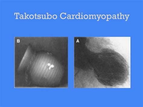 Takotsubo Cardiomyopathy Broken Heart Syndrome Ppt