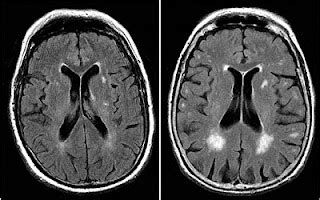 Health Information Guides: Brain MRI White Matter Intensities: Clinical Significance