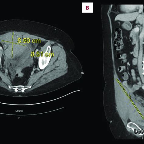 A Transverse Ct Section And B Sagittal Ct Section Of The Pelvis An