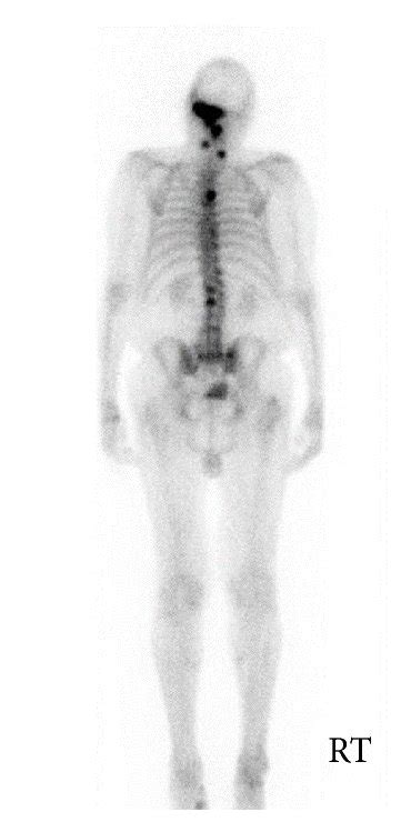 Nuclear medicine bone scan, using technetium 99m-MDP, posterior view ...