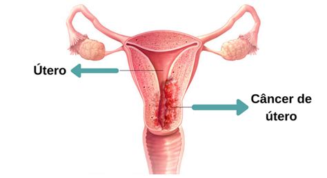 Quais Os Sintomas De C Ncer No Colo Do Tero M Dico Responde