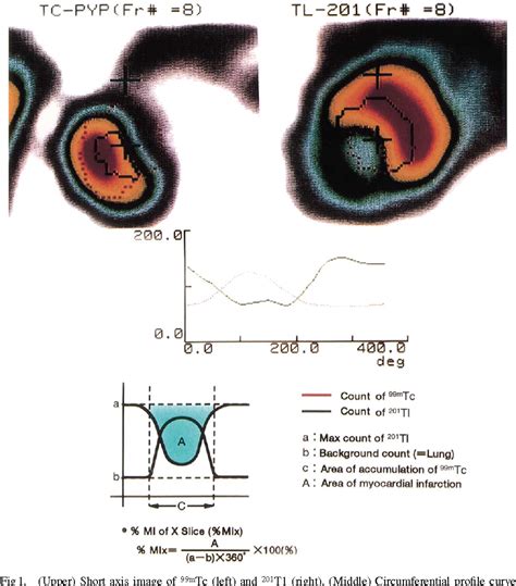 Figure 1 From L New Method Of Estimating Myocardial Infarct Size Using