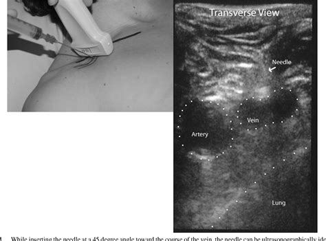 Figure 1 From Dynamic Multiplanar Real Time Ultrasound Guided