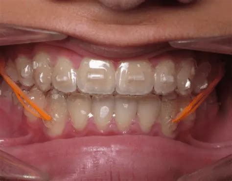 Gomas En Invisalign Qu Son Para Qu Sirven Y C Mo Pon Rselas