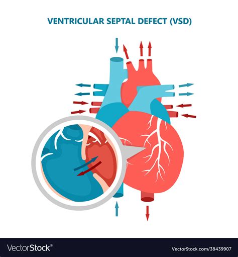 Ventricular Septal Defect Vsd With Heart Blood Vector Image