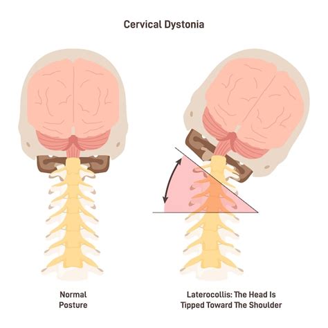 Diston A Cervical Tort Colis Espasm Dica Estado Inflamatorio Del Cuello