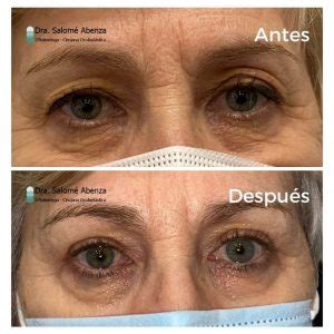 Blefaroplastia Superior Bilateral Antes Y Despu S Salom Abenza