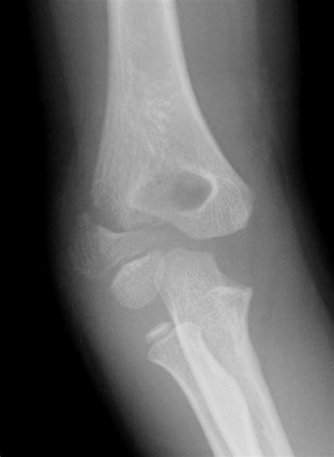 Lateral Condyle Fractures The Bone School