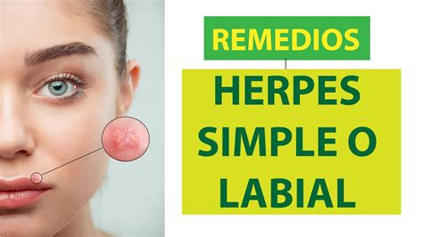 Combate El HERPES LABIAL Con 4 REMEDIOS NATURALES YouTube