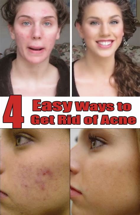 Natural Skin Healing 4 Easy Ways To Get Rid Of Acne