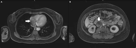 Leiomyomatosis Reaching The Right Atrium A Through The Inferior Vena