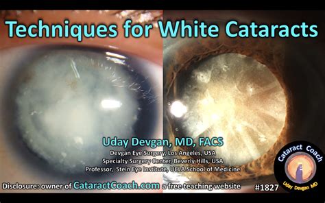 1827 White Cataract Review Cataract Coach