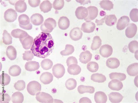 Neutrophil cell (white blood cell) in blood smear, analyze by ...