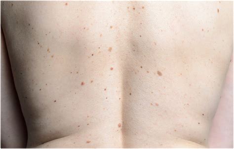 What are Moles (Symptoms & Causes) - A Detailed Study on Skin Moles