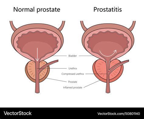 Normal Vs Prostatitis Prostate Comparison Diagram Vector Image