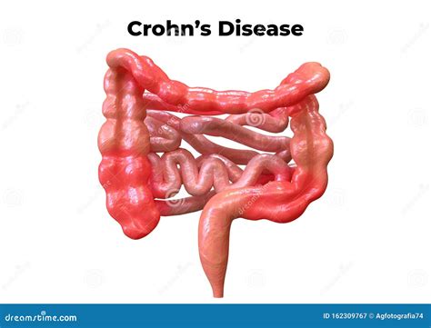 De Ziekte Van Crohn Is Een Syndroom Dat Het Spijsverteringssysteem