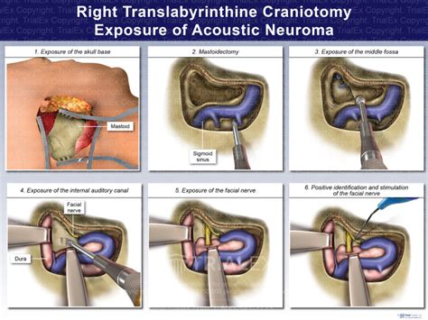 Right Translabyrinthine Craniotomy Exposure Of Acoustic Neuroma