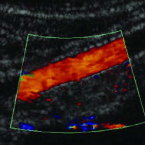 An arterial duplex ultrasound image showed a patent axillary artery ...