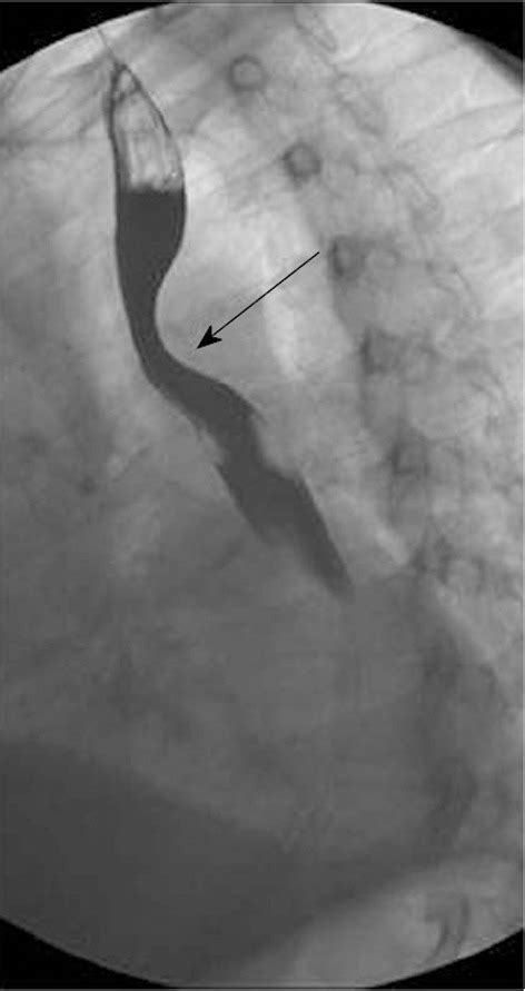 Mdct Of Right Aortic Arch With Aberrant Left Subclavian Artery