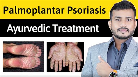 Palmoplantar Psoriasis Me Hone Wala Psoriasis Palmoplantar