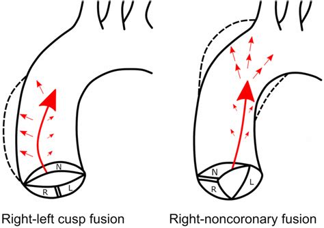 Scheme Of The Of The Bicuspid Aortic Valves With Different Type Of Cusp