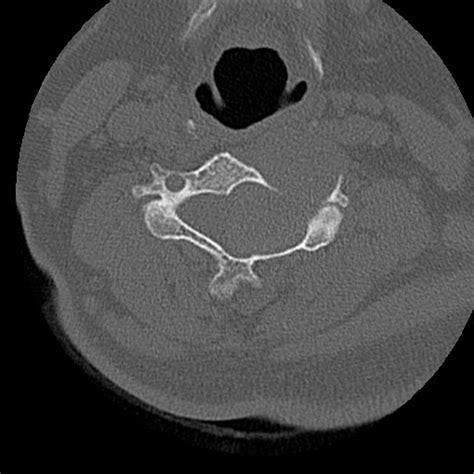 Cervical Spinal Neurofibroma In A Patient With Nf Radiopaedia