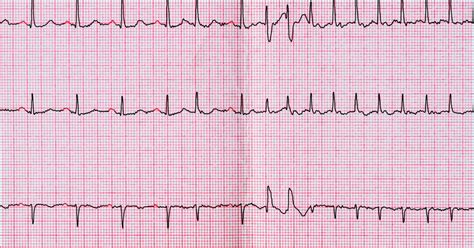 Wearable heart monitors reveal otherwise undetected atrial fibrillation ...