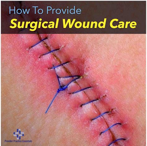 Providing Surgical Wound Care And Understanding The Types Of Healing