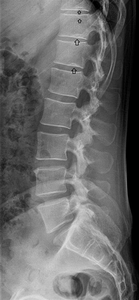 Radiografia Hernia Lumbar