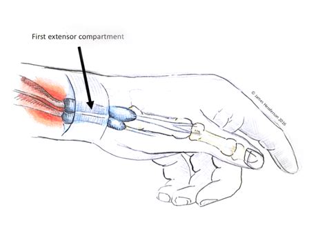 De Quervains Syndrome De Quervains Tenosynovitis James Henderson