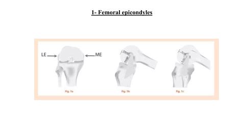 Surgical Landmarks In Revision Total Knee Ppt