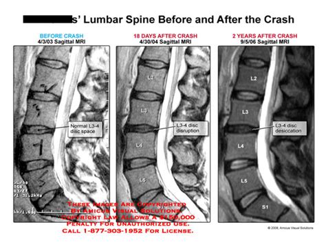 Amicus Illustration Of Amicus Injury Radiology Lumbar Disc Normal Mri