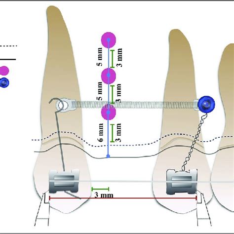 Micro Osteoperforation And Tooth Movement A Randomized Controlled