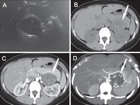 Clinical Features And Retroperitoneal Laparoscopic Resection Of Adrenal