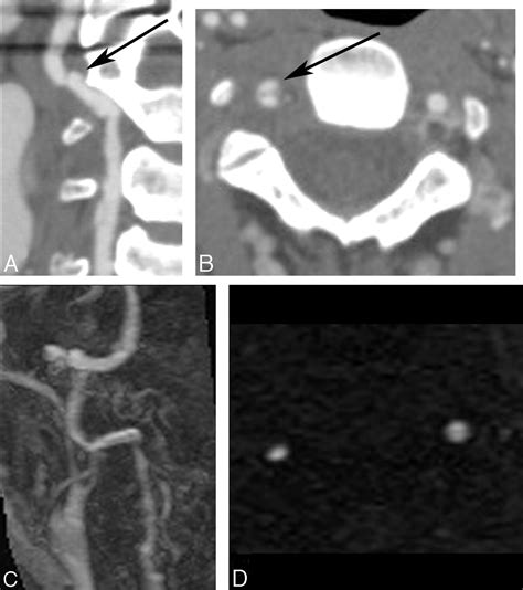 Vertebral Artery Dissection Mri