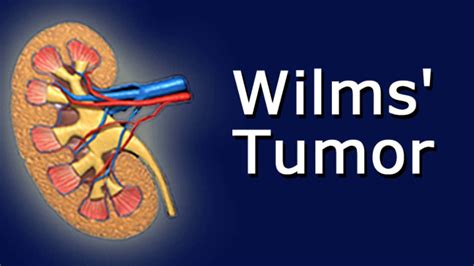 Wilms' Tumor - YouTube