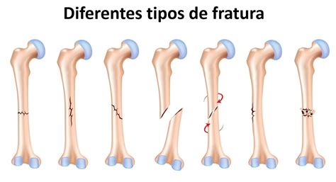 Entorses Luxa Es E Fraturas S O Exemplos De Les Es Musculoesqueleticas