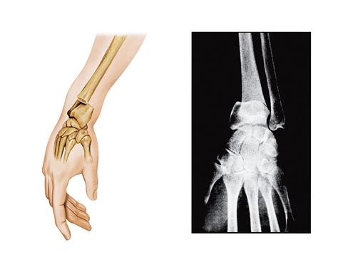 Colles Fracture 1 By Asklepios Medical Atlas