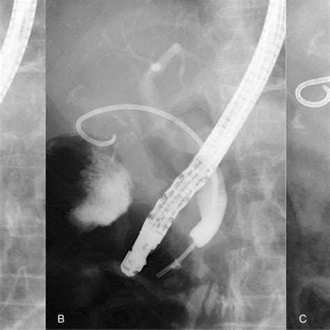 Common Bile Duct Stone Including Stent Stone Complex Formation