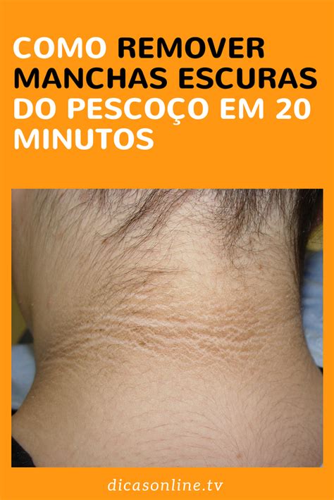 Manchas Escuras No Pescoço O Que Pode Ser - Receitas naturais para remover manchas escuras e clarear pescoço e ...